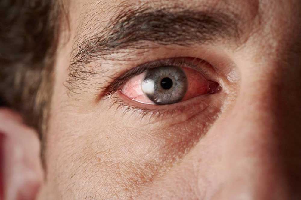 Common Causes of Blood Vessel Burst in the Eye