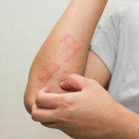 Here&#8217;s all that you need to know about scabies skin rash