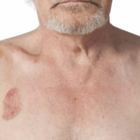 How to effectively treat hematomas at home