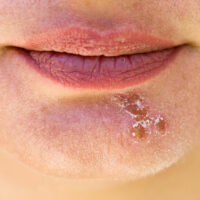 Popular essential oils to bid goodbye to cold sores