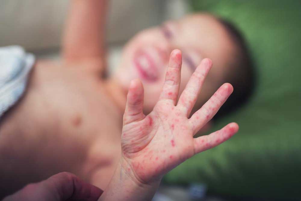 Prevention Tips for Hand, Foot, and Mouth Disease