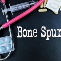 Prevention and Treatment for Bone Spurs