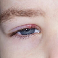 Remedies to get rid of stye