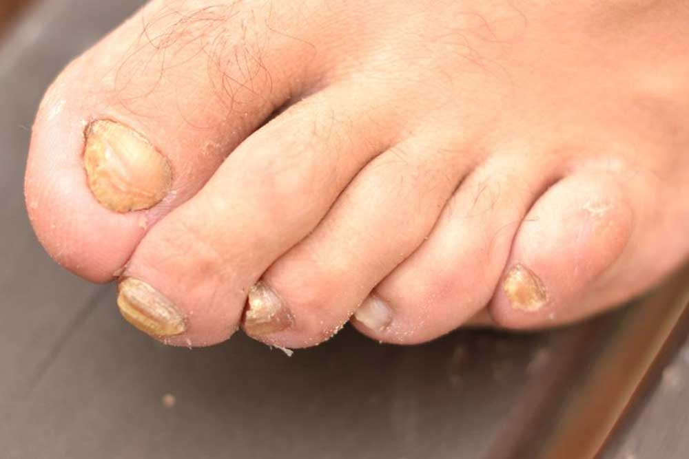 Tips to Treat Nail Fungus Effectively