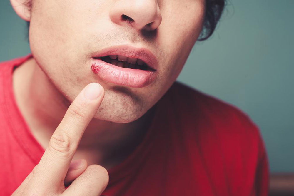 Top 4 FAQs about cold sores