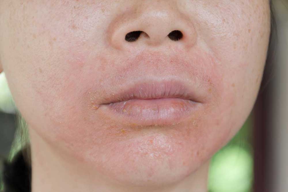 Treatment Methods for Lupus Skin Rashes