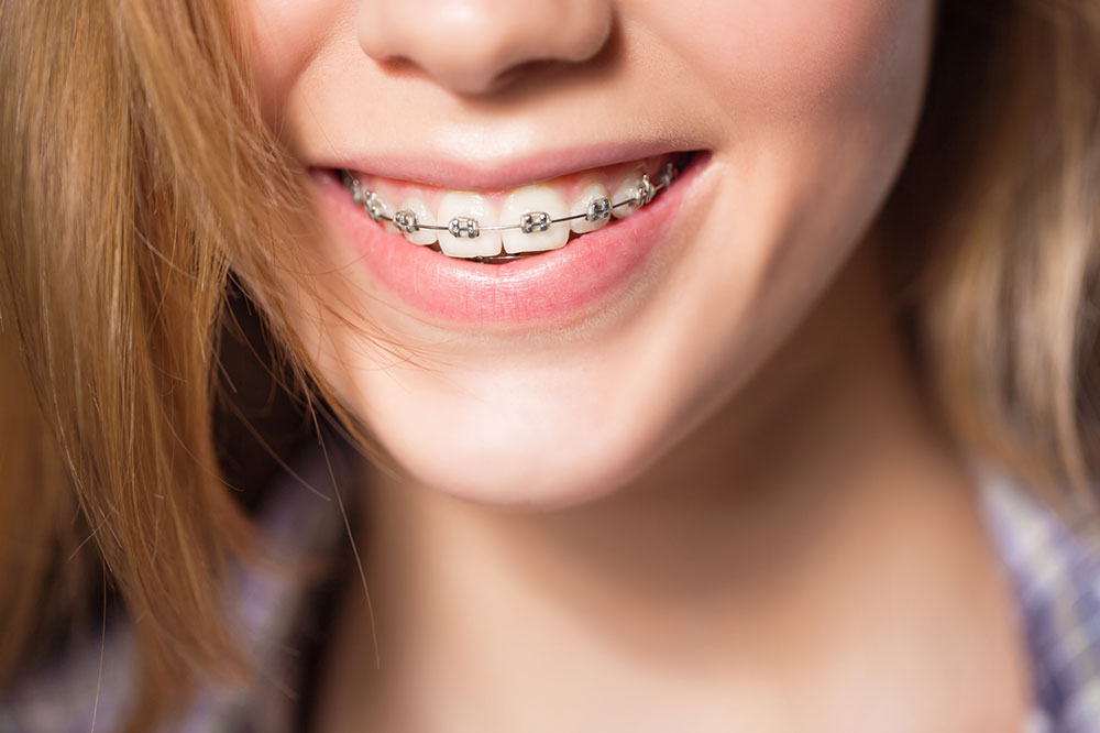 4 common types of teeth braces for adults