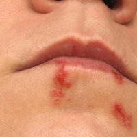 6 Effective Remedies for Treating Cold Sores