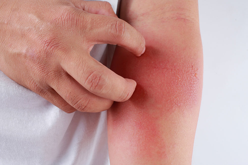 3 Effective Home Remedies to Manage Eczema Symptoms