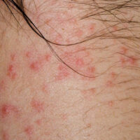 An Introduction to the Types of Itchy Skin Rashes