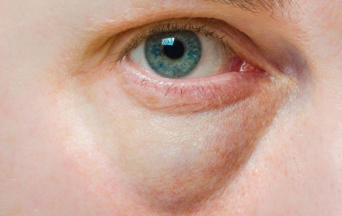 Bags Under the Eyes &#8211; Symptoms, Causes, and Treatment