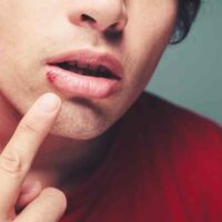 Effective Home Remedies for Treating Cold Sores