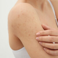 Everything You Need To Know About Hiv Skin Rash