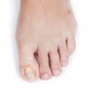 How to Treat Fungal Infections in the Toenails