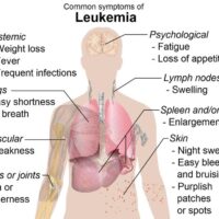 Is your Body Telling You About these Leukaemia Symptoms?