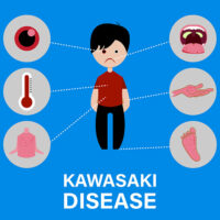 Kawasaki disease &#8211; causes and symptoms