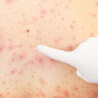 Remedies to Treat Keratosis Pilaris at Home