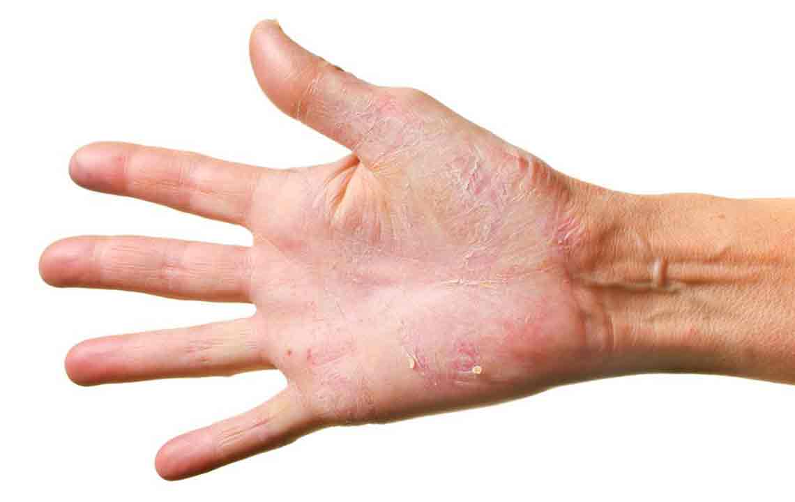 Six creams that can cure eczema