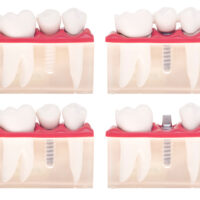 The various types of crowns and caps