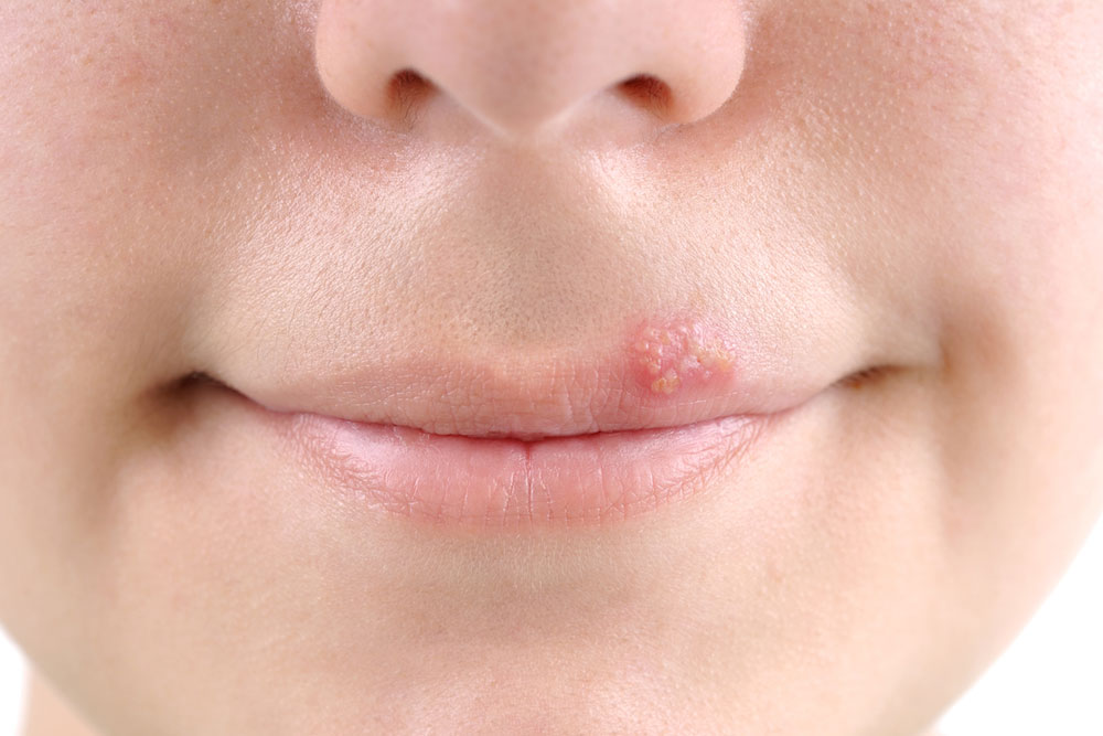 Tips to Treat Cold Sores Effectually